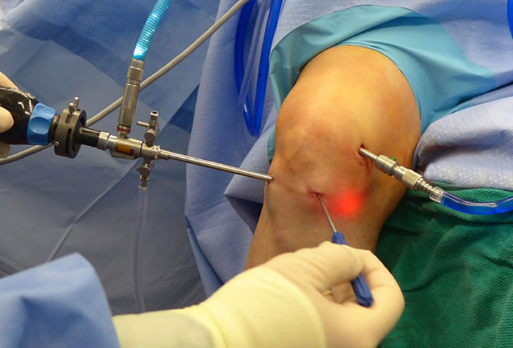 Cirugía de rodilla